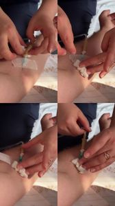绿丝玉导管必备素材_护士必学技巧